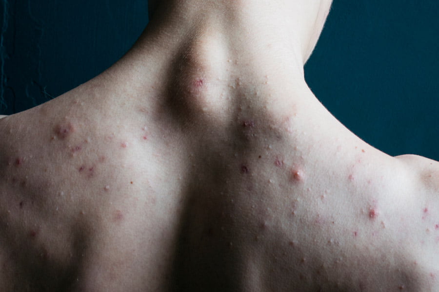Example of skin with acne issues