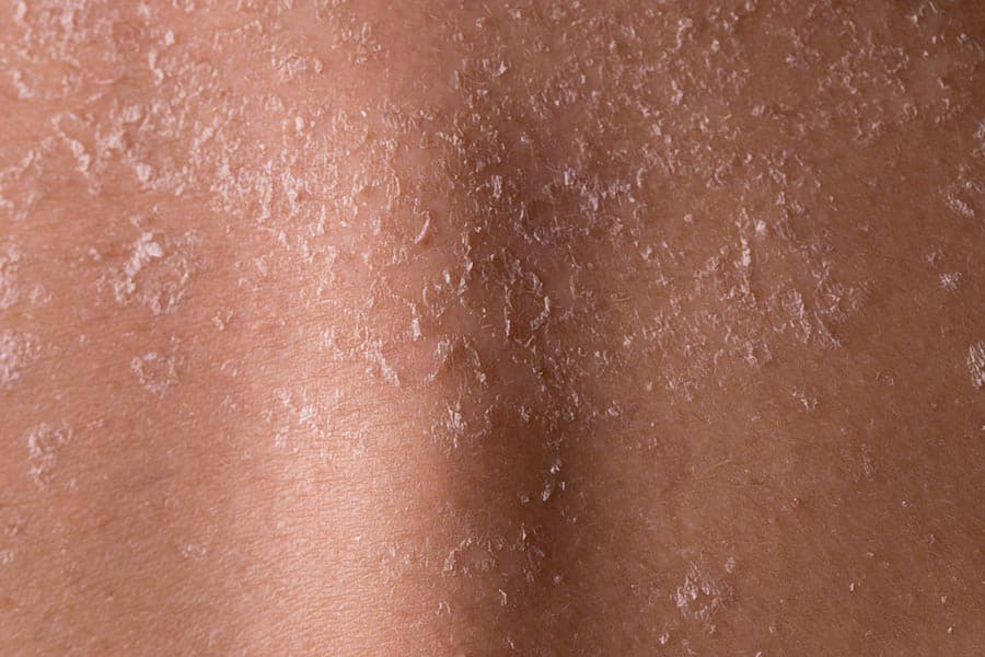 piel cuerpo sensible 