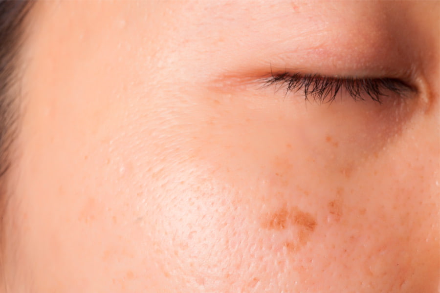 Skin with hyperpigmentation