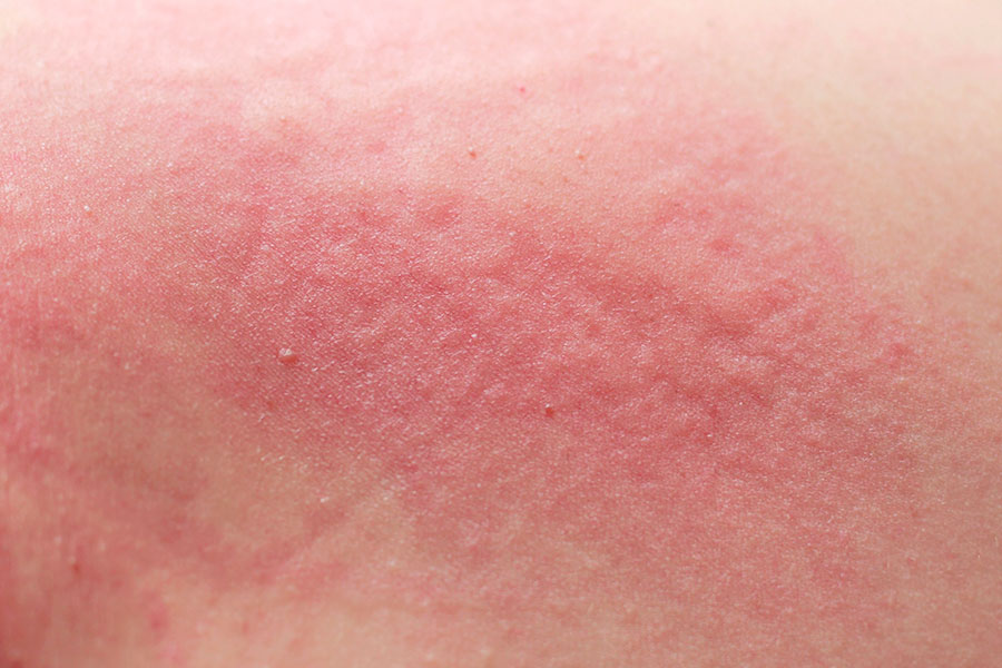 Example of reddened skin