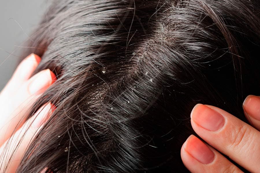Tratamientos anticaspa para el cabello – CarasaLab Ejemplo de pelo con caspa